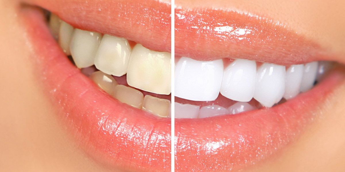 درمان تغيير رنگ دندان